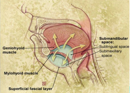 <p>cellulitis of the sublingual and submaxillary spaces often arising from infection of the mandibular dentition, <strong>bilateral</strong></p><p>-most often arises from a dental infection, caused by normal oral flora </p>