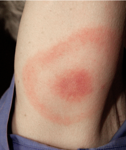 <p>Abnormal Skin Pigmentation Finding</p><ul><li><p>In dark-skinned client may be difficult to see. However, the affected skin feels <strong>swollen</strong> and <strong>warmer</strong> than the surrounding skin.</p></li><li><p><strong>Reddish</strong> discoloration of skin usually caused by <strong>inflammation</strong> or <strong>trauma</strong></p></li><li><p><strong>Heated</strong> skin temperature</p></li></ul><p></p>