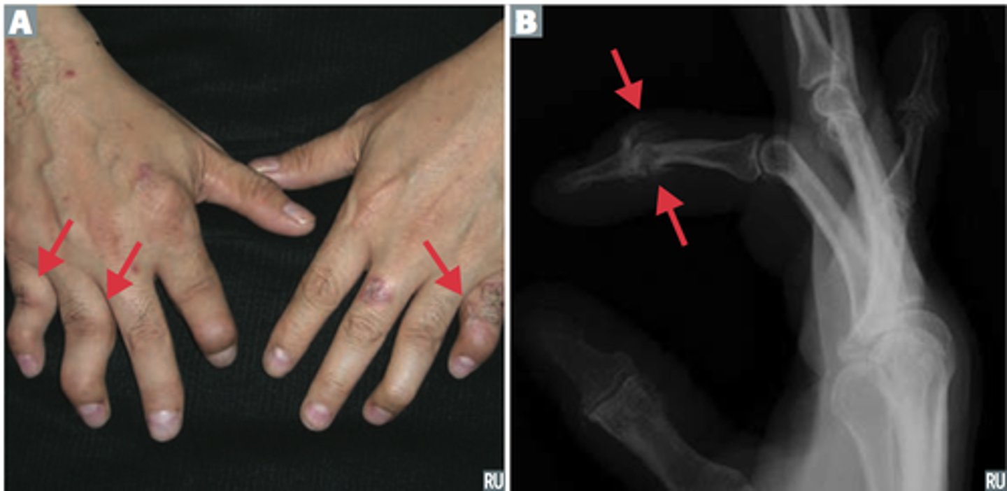 <p>What is it?</p><p>- one of the seronegative spondyloarthropathies (PAIN)</p><p>- associated with HLA B27</p><p>- seen in less than 1/3 psoriasis patients</p><p>Findings?</p><p>- skin psoriasis and nail lesions</p><p>- asymmetric and patchy involvement</p><p>- dactylitis and "pencil in cup" deformity of DIP on xray</p>