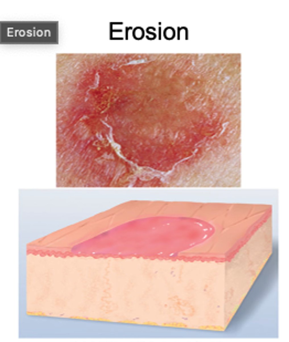 <p>Loss of part of the epidermis</p><p>Presents as depressed and moist area, follows a ruptured vesicle or bulla</p>