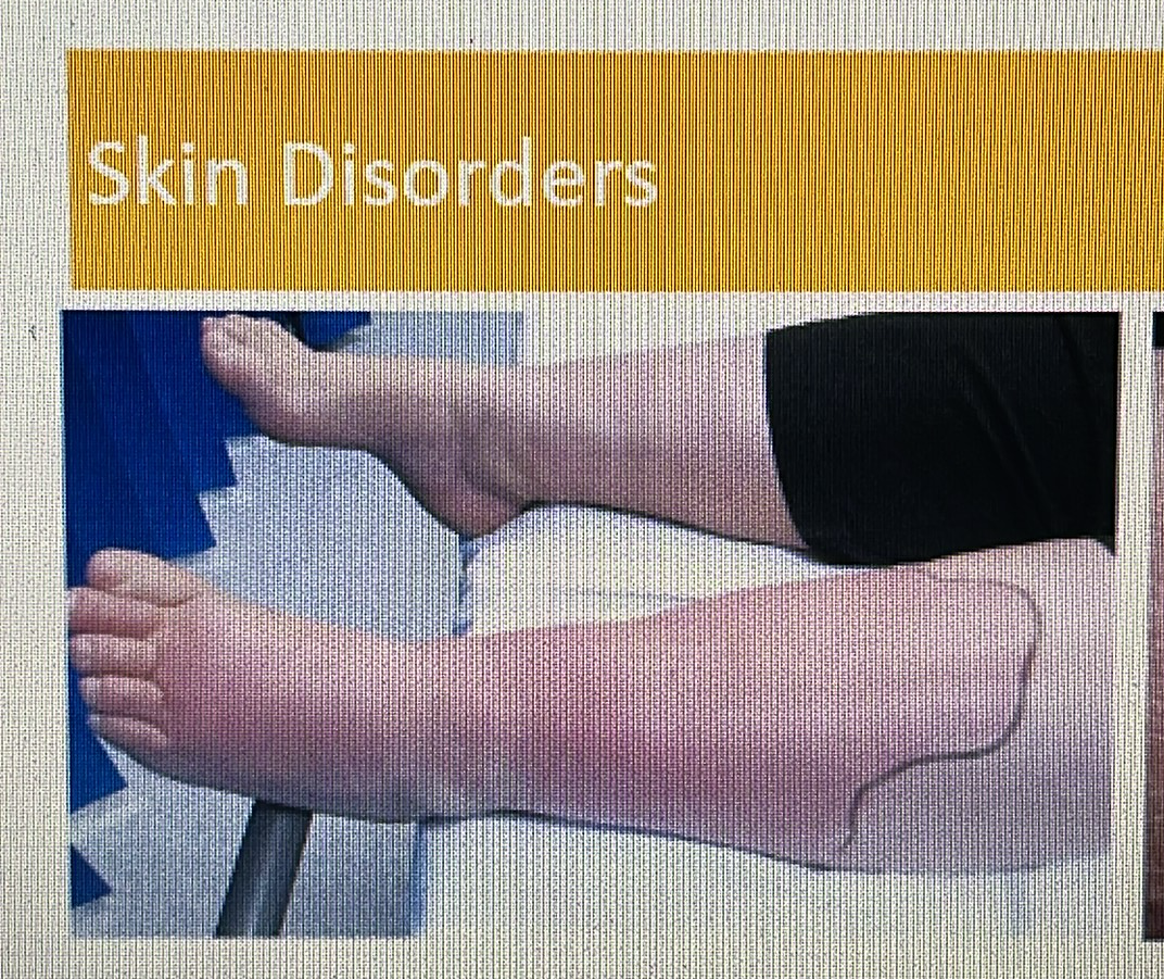 <p>SKIN DISORDER</p><p>Cellulitis</p>