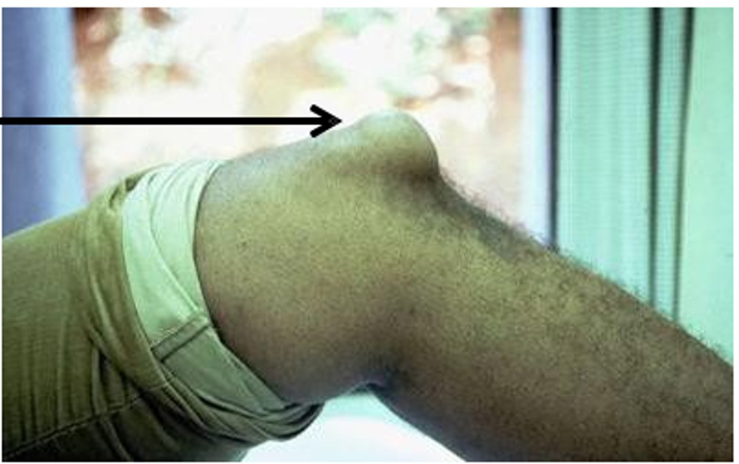 <p>Prepatellar bursitis after repetitive pressure on the knee</p>
