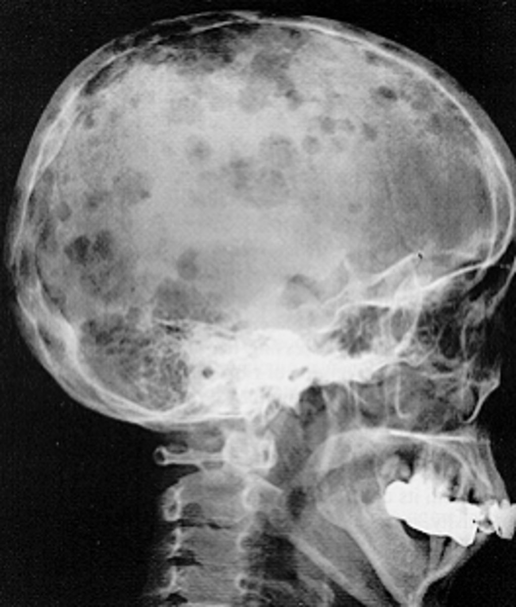 <p>These malignancy presents with multiple punched-out lesions of the scull:</p>