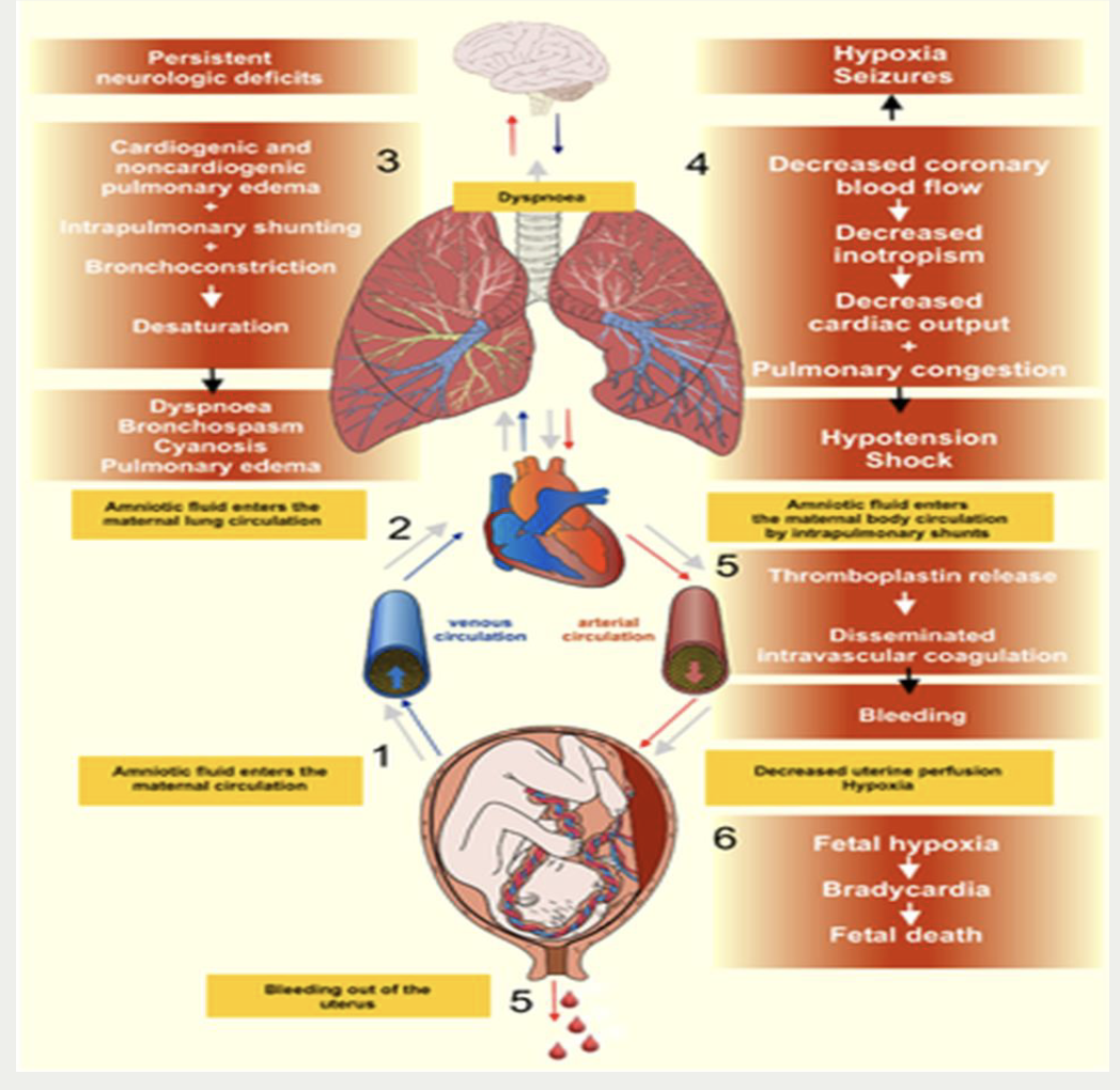 <p><strong>signs and symptoms</strong></p><ul><li><p>respiratory - restless / altered LOC, dyspnea, cyanosis —&gt; respiratory arrest</p></li><li><p>circulatory - hypotension, tachycardio, schock —&gt; cardiac arrest</p></li><li><p>hemorrhage (DIC) - profuse bleeding, petechiae, echhymosis, uterine atony</p></li></ul><p></p><p><strong>management</strong></p><ul><li><p>call for additional assistance - anesthesia</p></li><li><p>o2 via non rebreather mask</p></li><li><p>position side lying</p></li><li><p>administer iv fluids blood products</p></li><li><p>prepare for cpr and intubation as needed</p></li><li><p>emergency cesarean</p></li></ul><p></p>