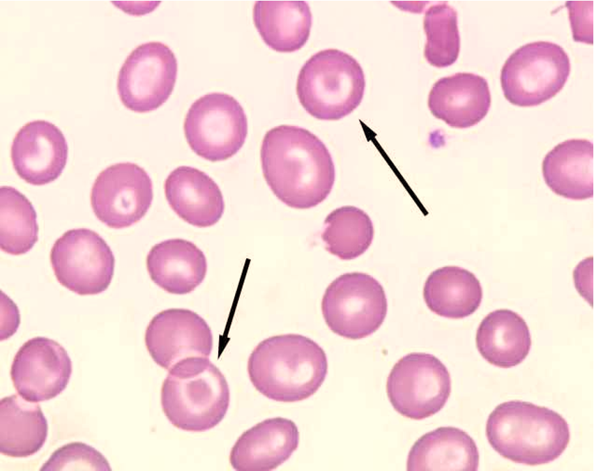 <p><span>cells with large portion of hemoglobin displayed at the rim of the cell and a portion of hemoglobin either central, eccentric, or banded</span></p><ul><li><p><span><u>Always</u> hypochromic</span></p></li></ul><p></p>