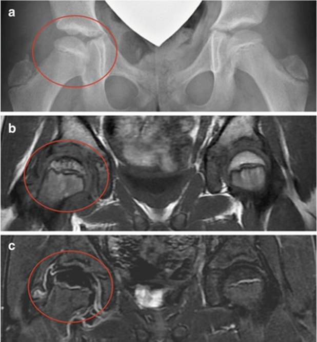 <p><strong>idiopathic pediatric avascular necrosis the proximal femoral epiphysis of hip due to disruption of blood supply</strong><br><span>-</span><span style="color: blue"><strong>typically 4-8yo</strong></span><span>, AMAB:AFAB 5:1, typically unilateral</span><br><br><span>S/S: insidious onset, can have </span><strong>painless limp or intermittent groin, hip, thigh pain</strong><br><span>PE: stiff ROM, loss of internal rotation, ABduction, limp/Trendelenburg gait (dropped hip), limb length inequality (later stages)</span><br><br><span>Dx: XRAY (initial); MRI with neg XRAY and high suspicion</span><br><span>Tx: </span><strong>observation; </strong><span>NSAIDs, activity restriction (swim/bike), PT for ROM</span><br><span>→</span><strong>good outcomes in 60% </strong><em>(hip is never completely normal, risk for early osteoarthritis)</em><strong> </strong><em>surgical: reserved for severe cases generally after 8yo</em></p>