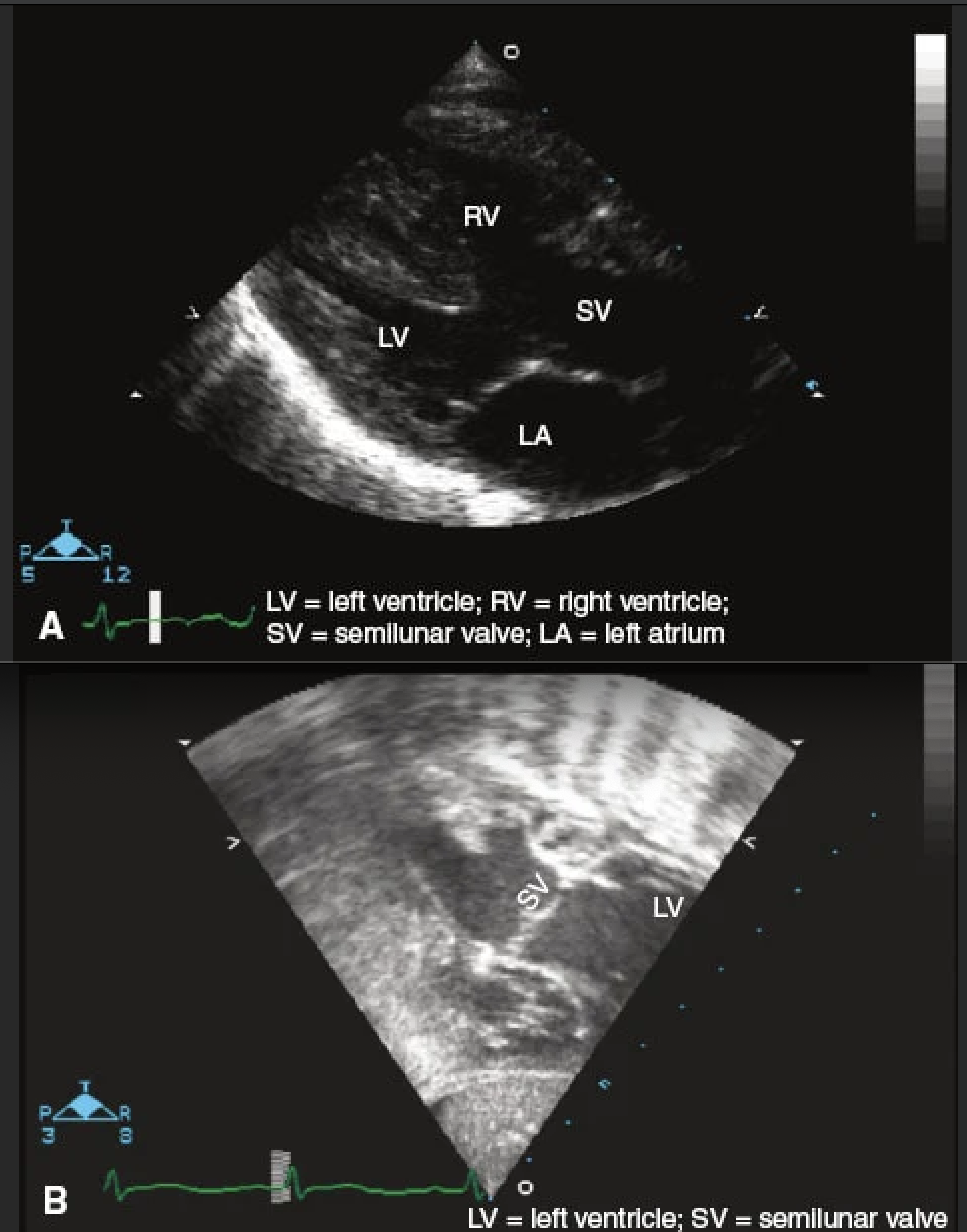 <p>6 week old infant with poor feeding, respiratory distress and mild cyanosis. CXR with pulm vasc congestion. Diagnosis?</p>