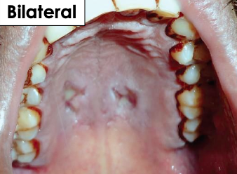 <p>What is the clinical manifestation of Necrotizing Sialometaplasia?</p>