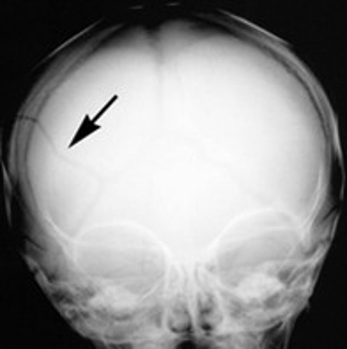 <p>a fracture of the bony structure of the head</p>