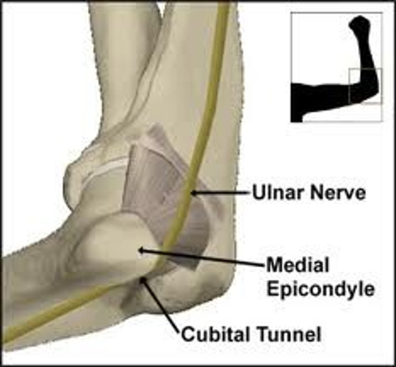 <p>between medial epicondyle and olecranon process</p><p>ulnar nerve passes through</p>