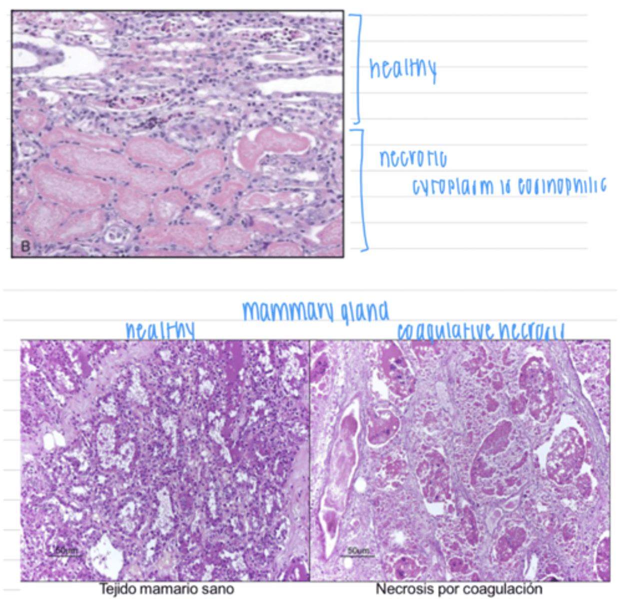 <p>pyknotic, karyorrhetic, or absent nucleus</p><p>eosinophilic cytoplasm</p>