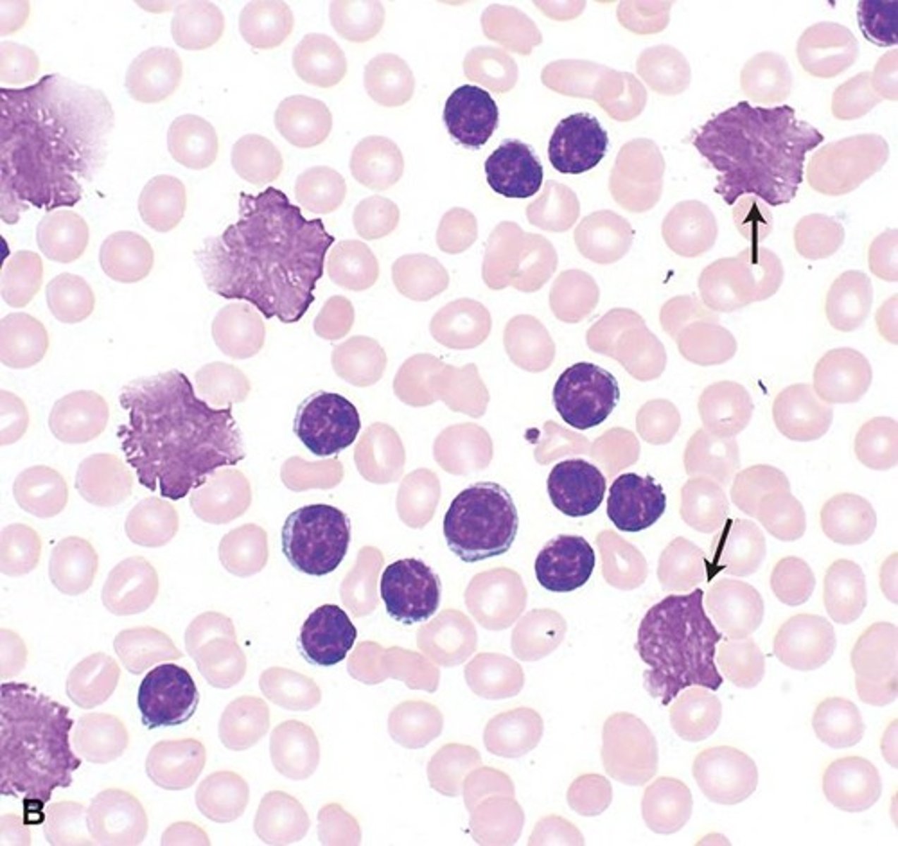 <p>lymphocytes that look flattened/smudged when a peripheral smear is obtained; these cells are fragile and are easily distorted when cover slide is placed on the sample</p>