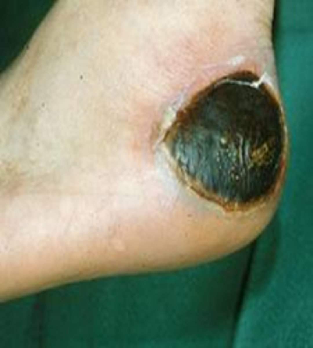 <p>WOUND BED ASSESSMENT</p><p>dry, hard, very adherent "scab" with some degree of thickness</p><p>*black, yellow/brown</p><p>**DO NOT REMOVE FROM ARTERIAL WOUND</p>