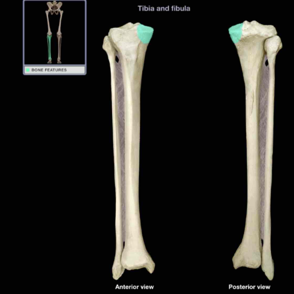 <p>Medial condyle of tibia</p>