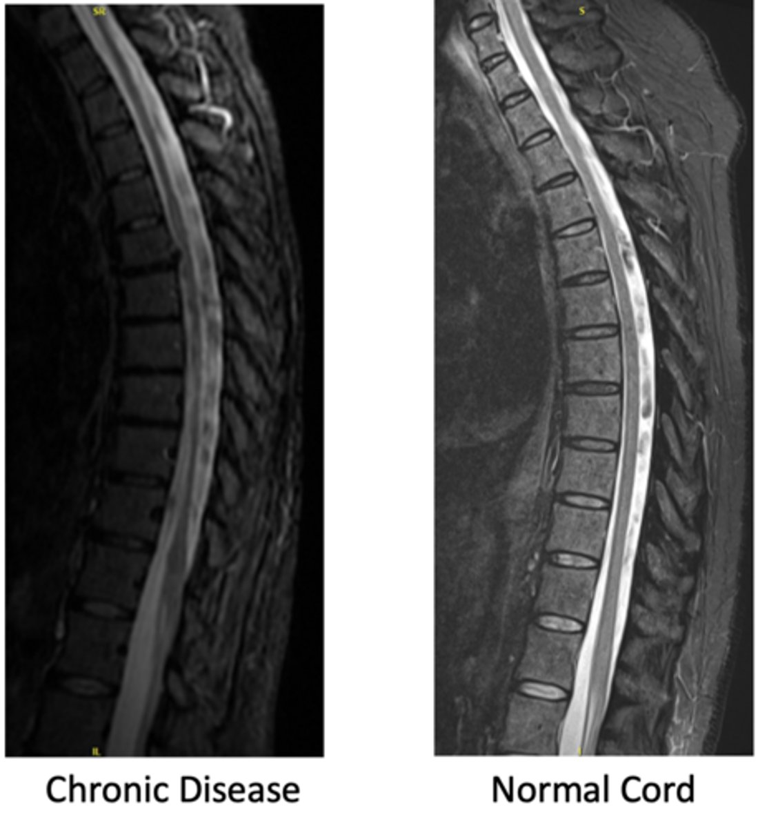 <p>decreased CSF with possible stenosis</p>