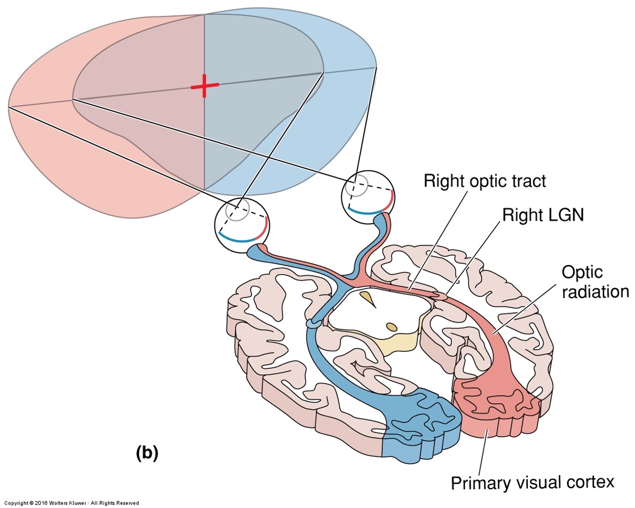 <ul><li><p><strong>Optic nerve lesion (one side):</strong> blindness in that eye.</p></li><li><p><strong>Optic chiasm lesion:</strong> loss of peripheral (temporal) fields in both eyes → <strong>bitemporal hemianopsia</strong>.</p></li><li><p><strong>Optic tract lesion:</strong> loss of contralateral visual field in both eyes → <strong>homonymous hemianopsia</strong>.</p></li><li><p><strong>LGN or visual cortex lesion:</strong> similar contralateral field loss, sometimes with macular sparing (due to dual blood supply).</p></li></ul><p></p><p>Textbook</p><ul><li><p>Objects in the <strong>left visual field</strong> are seen by the <strong>nasal retina</strong> of the <strong>left eye</strong> and the <strong>temporal retina</strong> of the <strong>right eye</strong>.</p></li><li><p><strong>Nasal retinal fibers cross</strong> at the <strong>optic chiasm</strong>, sending all <strong>left visual field</strong> information to the <strong>right hemisphere</strong>.</p></li><li><p>Conversely, the <strong>right visual field</strong> is processed by the <strong>left hemisphere</strong>.</p></li><li><p><strong>Rule of thumb:</strong> left field → right brain; right field → left brain.</p></li><li><p>This crossing (<strong>decussation</strong>) also occurs in motor pathways, where each brain side controls the <strong>opposite body side</strong>.</p></li></ul><p><span>Remember…</span></p><ul><li><p style="text-align: left;"><span>left visual field is imaged on the <strong>nasal retina of the left eye and the temporal retina of the right eye (RED in figure)</strong></span></p></li><li><p style="text-align: left;"><span><strong>r</strong>ight visual field is image on the <strong>nasal retina of the right eye and the temporal retina of the left eye (BLUE in figure)</strong></span></p></li></ul><p><span>A)Transection of the left optic nerve (#1)</span></p><ul><li><p style="text-align: left;"><span><strong>Left Optic Nerve</strong> → all vision contributed by the left eye, but remember most of the left visual field is also viewed by right eye, so you only lose the monocular vision portion of the left hemifield (<strong>far left peripheral vision</strong>)</span></p></li></ul><p><span>B)Transection of the left optic tract (#3)</span></p><ul><li><p style="text-align: left;"><span><strong>Left Optic Tract </strong>&nbsp;→ all of right visual hemifield</span></p></li></ul><p><span>C)Transection of the optic chiasm (#2)</span></p><ul><li><p><span><strong>Optic Chiasm </strong>&nbsp;→ only crossing fibers (from nasal retinas) are loss→ peripheral vision&nbsp;</span></p></li><li><p><span>ex: Left nasal retina views the left peripheral vision (part A of the figure)</span></p></li></ul><p></p>