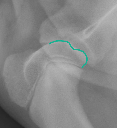 <p>Osteochondrosis is a group of disorders of bone development most commonly in large dog breeds on the humeral head (followed by femoral condyles)</p><p>It is caused by epiphyseal ischemia, which results in defective growth of the subchondral bone</p><p>The overlying articular cartilage becomes excessively stressed and tears, resulting in the formation of a cartilage flap</p>
