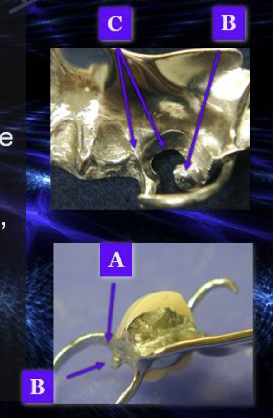 <ul><li><p>areas: above the survey line</p><ul><li><p>shoulder region of circumferential clasps A</p></li><li><p>under rests B</p></li><li><p>on minor connectors and interproximal extension of lingual plates C</p></li></ul></li></ul><p></p>