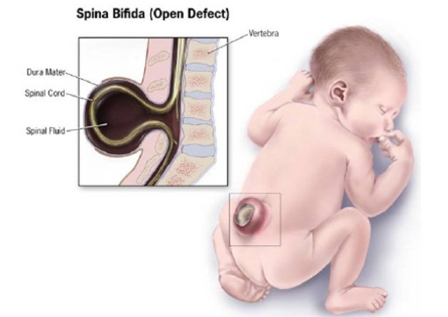 <p>1) Anemia (Megaloblastic) - fatigue, headaches, difficulty concentrating, shortness of breath, palpitations</p><p>2) Neural Tube Defects (Spina bifida & Anencephaly)</p><p>3) Miscarriage</p><p>4) Unstable DNA & inadequate DNA repair (causing cancer)</p><p>5) Malabsorptive diarrhea; lack of DNA replication in GI tract</p>