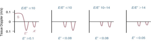 <p>diastolic dysfunction</p>