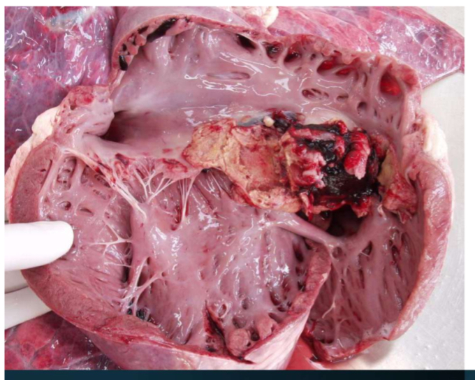 <ol><li><p><strong>What is this bovine organ?</strong></p><ol><li><p>Heart</p></li></ol></li><li><p><strong>Describe in 3 words- </strong>yellow deposits, sticky, melts in your hand</p></li><li><p><strong>Potential diagnosis-</strong> endocarditis</p><ol><li><p>Bacterial infection of the endocardium</p></li><li><p>Valvular or inner wall</p></li><li><p>Friable yellow/grey masses (vegetations form)</p></li><li><p>infective fragments detach and spread to other organs</p><ol><li><p>right side of lung</p></li><li><p>left side to kidneys and spleen</p></li></ol></li></ol></li><li><p><strong>Judgement- </strong>local rejection- category 2</p><ol><li><p>If embolic- total rejection</p></li></ol></li></ol><p></p>