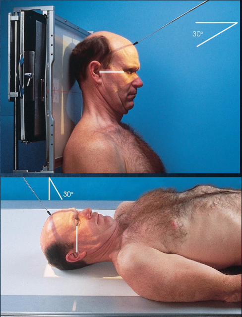 <ul><li><p>patient and part position:</p><ul><li><p>supine or upright, seated</p></li><li><p>MSP centered to midline</p></li><li><p>MSP perpendicular</p></li><li><p>OML perpendicular to IR</p><ul><li><p>IOML perpendicular if patient cannot flex neck enough</p></li></ul></li><li><p>top border of IR level with vertex</p></li><li><p>IR centered at or near foramen magnum</p></li></ul></li><li><p>respiration suspended</p></li><li><p>CR:</p><ul><li><p>directed through foramen magnum</p></li><li><p>OML: 30 degrees cacudal</p></li><li><p>IOML: 37 degrees caudal</p></li></ul></li><li><p>collimation:</p><ul><li><p>1 inch beyond the skin line of the skull</p></li></ul></li></ul><p></p><p></p>