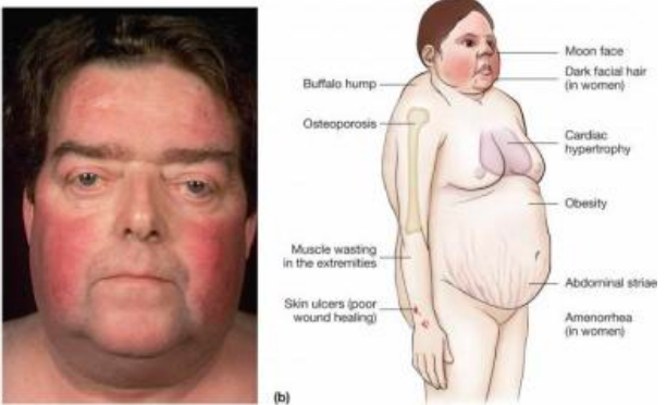 * “moon face”
* rounded face due to increased fat
* red cheeks
* excessive hair growth