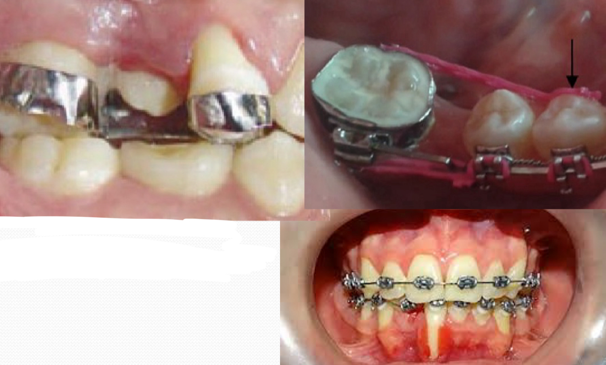<p>Badly adjusted bands</p><p>Bands with gingival overflowing bond</p><p>Periodontal effect</p><p>Recessions</p>