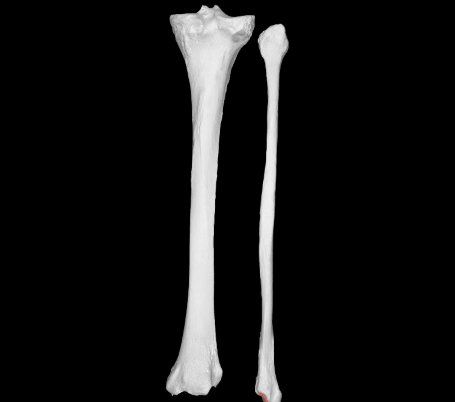 <p>deep indent on lateral malleolus of fibula </p>