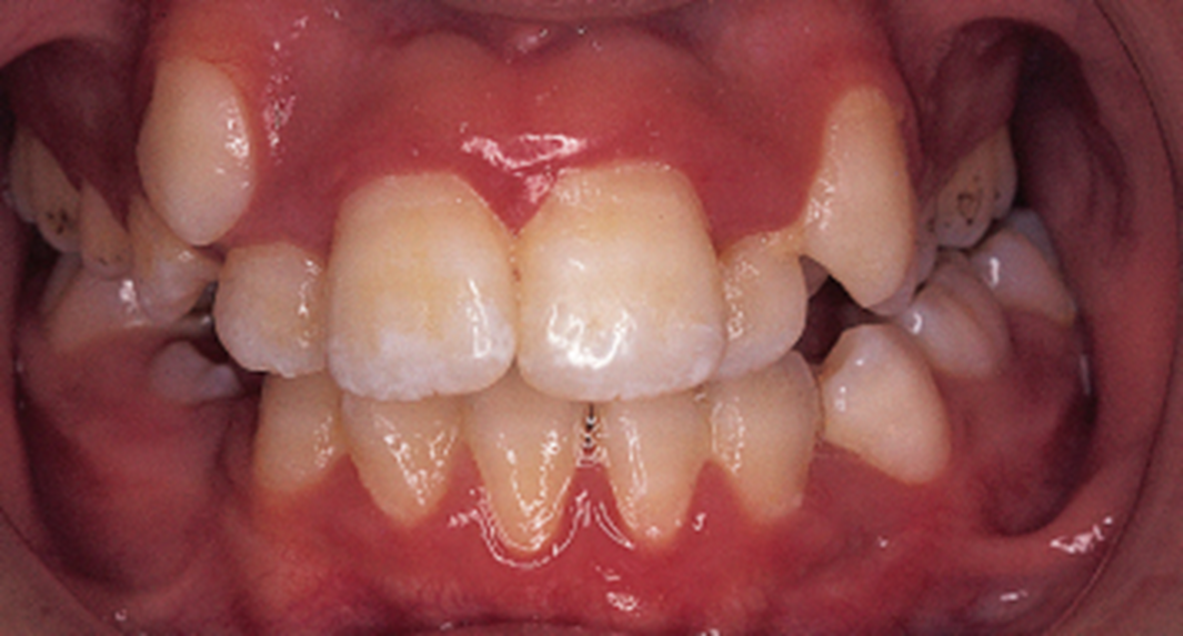 <p><span>•</span><span style="font-family: "Trebuchet MS";">The maxillary canines may erupt labially or lingually in relation to the surrounding teeth</span></p><p><span>•</span><span style="font-family: "Trebuchet MS";">The maxillary canines may also fail to erupt fully and may remain impacted</span></p><p><span>•</span><span style="font-family: "Trebuchet MS";">This occurs because the permanent maxillary canines erupt after the maxillary incisors and possibly after the premolars and their arch spaces have closed</span></p>