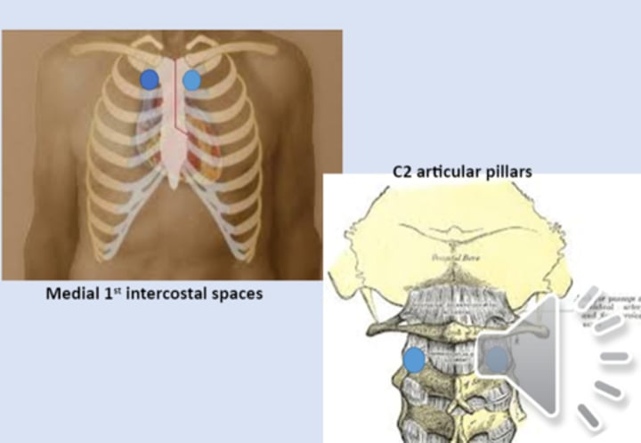 <p>anterior point: medial 1st intercostal space<br>posterior point: C2 articular pillars</p>