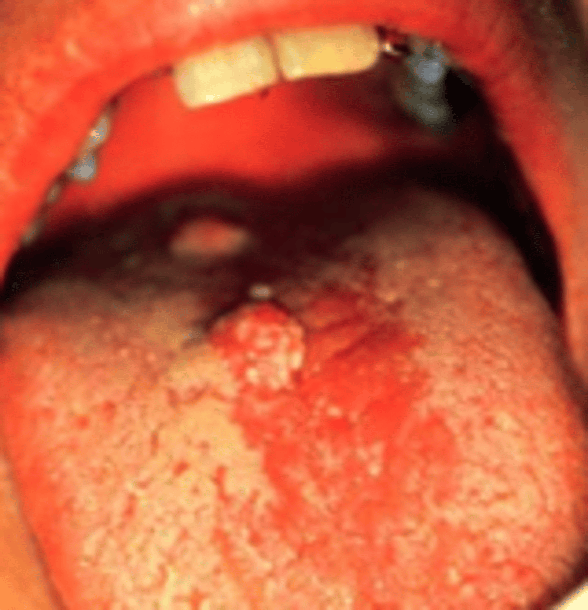 <p>High risk HPVs cause skin and cervical cancers (HPV16, HPV18)</p>