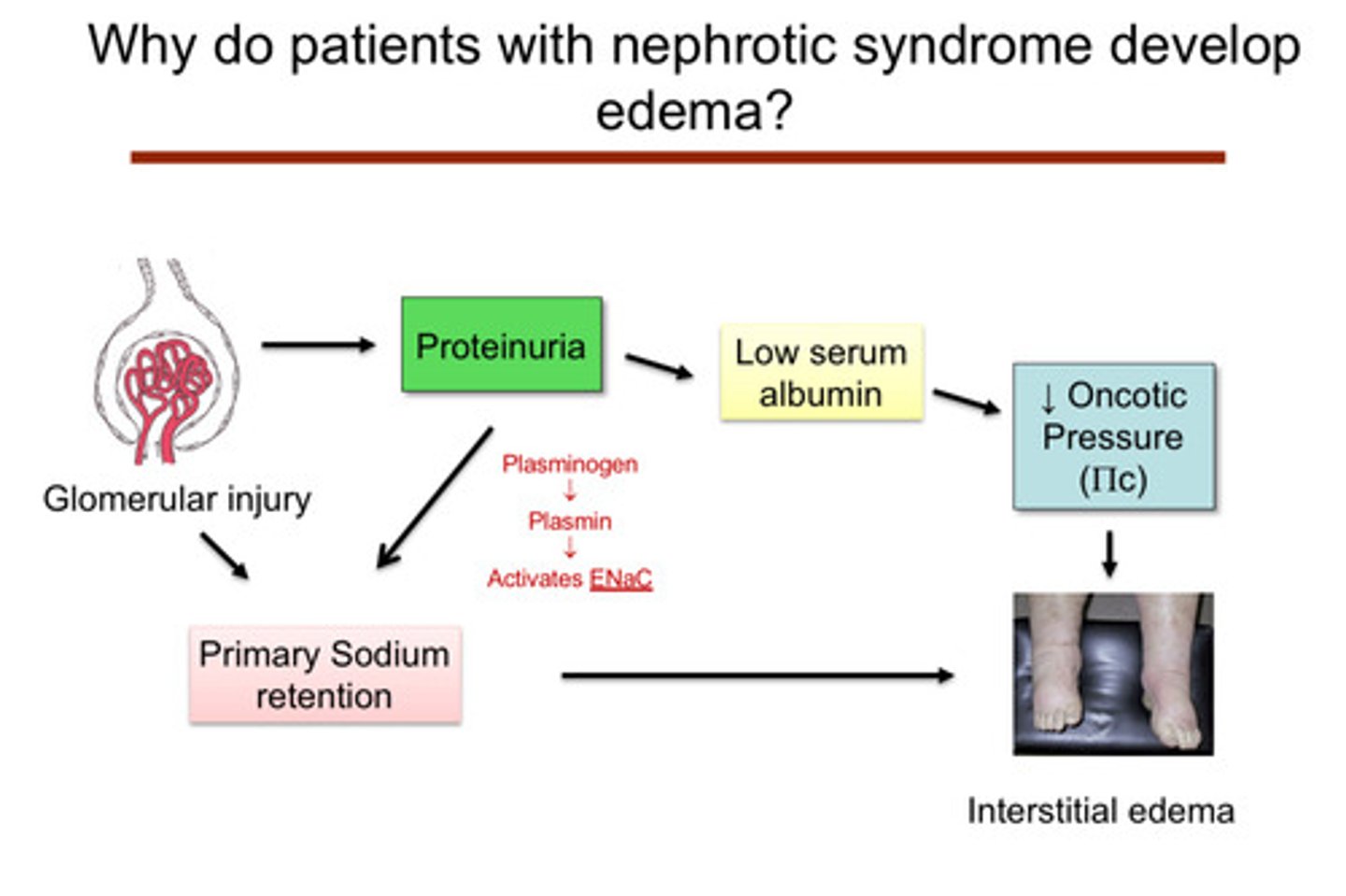 <p>glomerular injury can lead to:</p><p>1) proteinuria —&gt; low serum albumin —&gt; decreased oncotic pressure —&gt; interstitial edema</p><p>2) proteinuria —&gt; primary sodium retention via increased activation of ENaC by filtered plasminogen —&gt; plasmin (not due to decreased effective arterial blood volume w activation of RAAS/SNS)</p><p>2) primary sodium retention —&gt; interstitial edema</p>