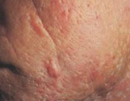 <p>secondary lesions, Acne w pitting and scarring</p>