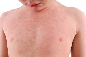 <p><strong>rash</strong></p><p>n</p>