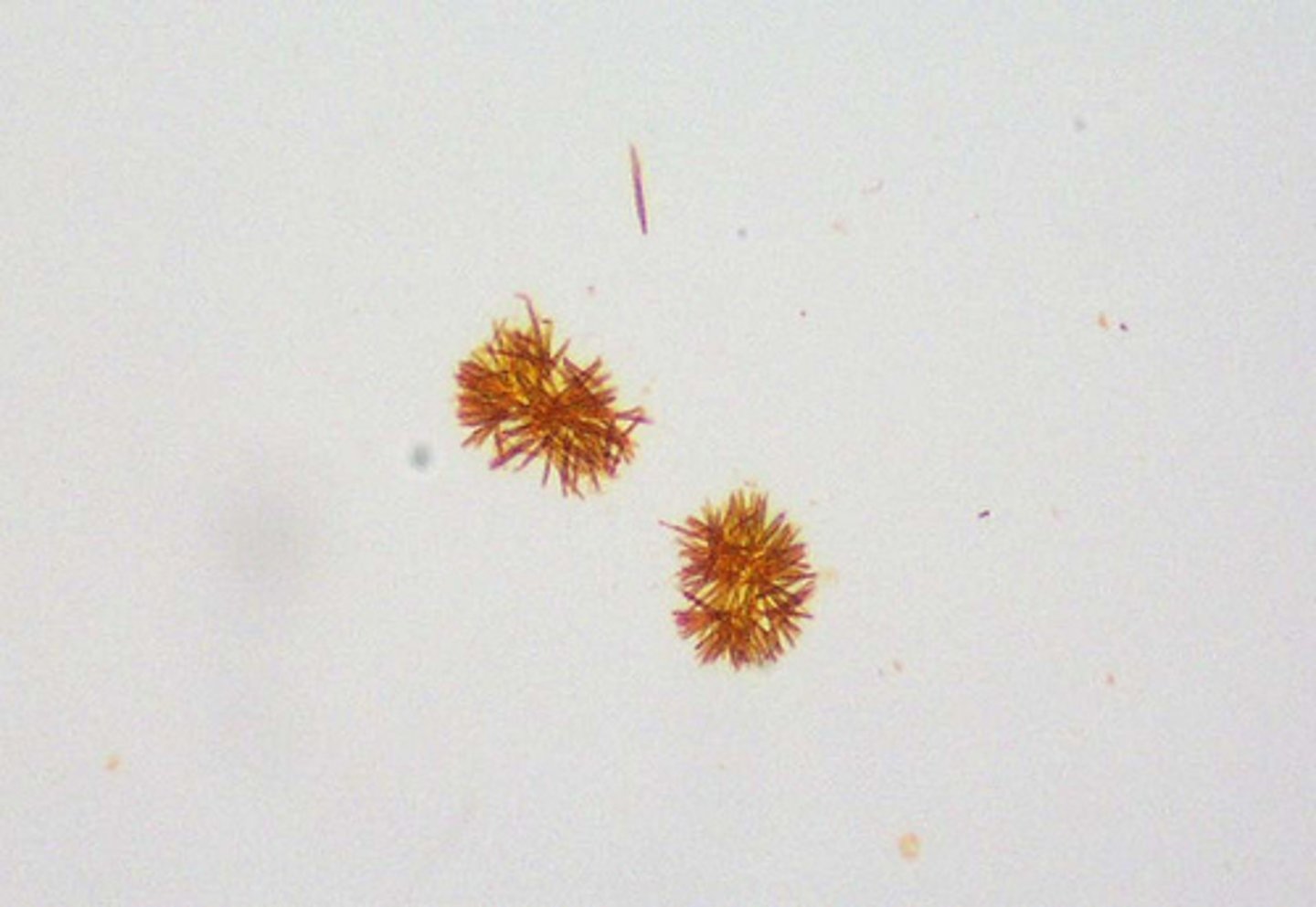<p>abnormal, bright yellow clumps-clumped needles/granules, liver disease</p>
