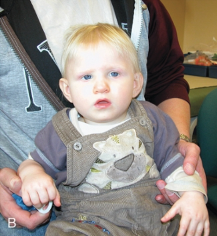 <p>Why is genetic counseling highly problematic for deletion 1q21.1 syndrome?</p>