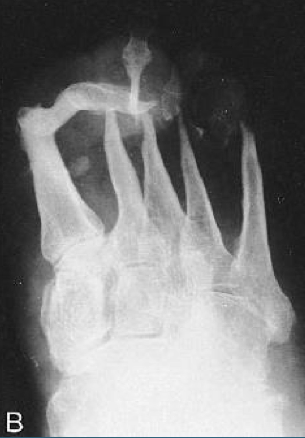 <p>what would this charcot joint be caused by </p>
