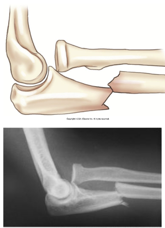 <ul><li><p>Fx of proximal half of ulna with dislocation of radial head</p></li><li><p>May happen if raise arms to block blows to the head</p></li></ul><p></p>