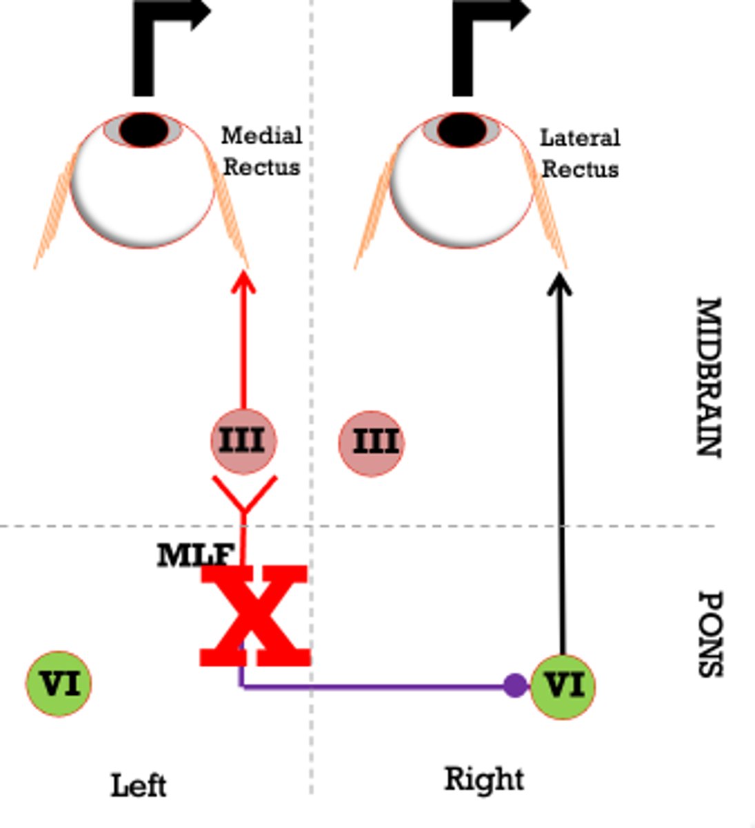 <p>ipsilateral eye cannot ADDuct d/t lack of input to ipsilateral medial rectus</p>