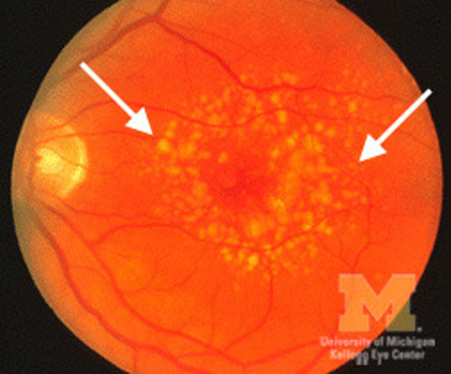 <p>Retinal drusen</p>