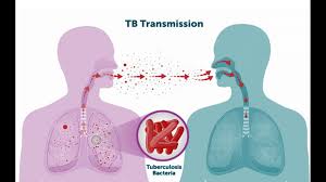 <p>Contagious bacterial infection of the lungs </p>