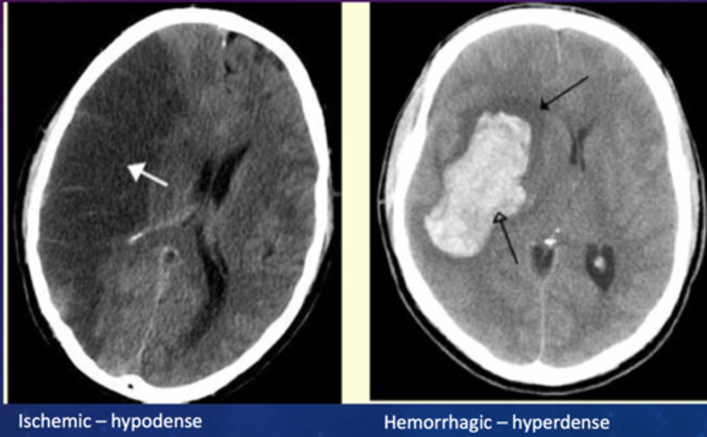 <p>Poorly controlled HTN</p>