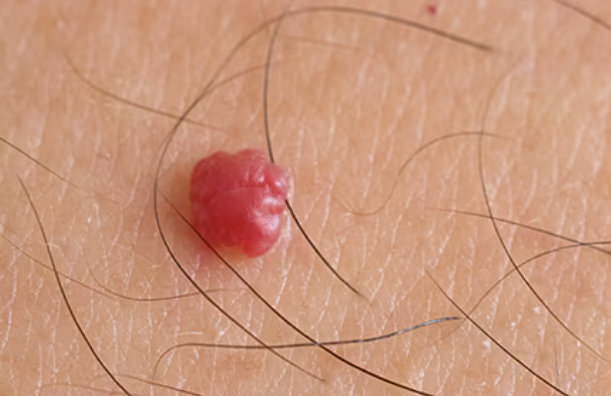 <p>what type of raised, primary skin lesion is this?</p>