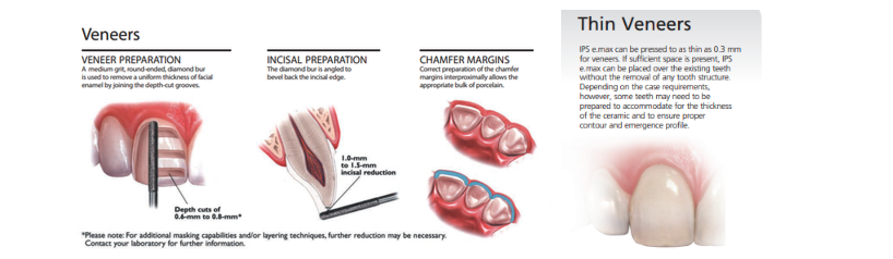 <ol><li><p>1-1.5 mm on incisal edge (if needed)</p><p></p></li><li><p>0.3 mm chamfer at gingival margin</p><p></p></li><li><p>0.5 mm reduction on most of facial surface</p><p></p></li><li><p>2-3 planes on facial surface</p></li></ol>