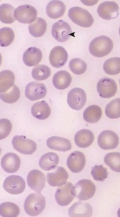 <p>8.3 Side A (PBD9: 390; BP9: 418)<br></p>
<p><br></p>
<p>Questions<br></p>
<p>A 19-year-old man from Ghana presents with recurrent fever, rigors, and dark urine. His hemoglobin is 6.9 g/dL, and peripheral smear is shown.<br></p>
<p><br></p>
<p>1. What parasitic infection does he have?<br></p>
<p>2. What is the intermediate host?<br></p>
<p>3. What is the life cycle of this organism?<br></p>