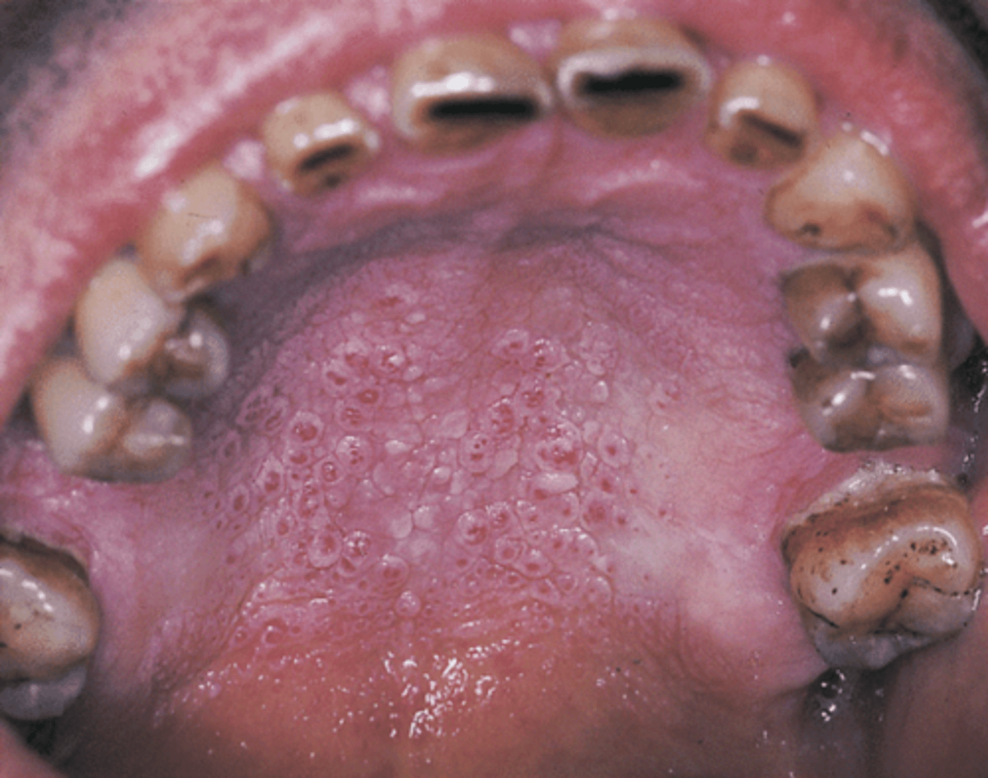 <p>nicotine stomatitis</p>