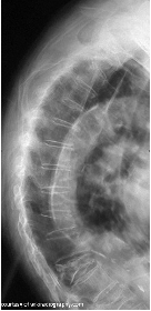 <p>Osteoporosis</p>