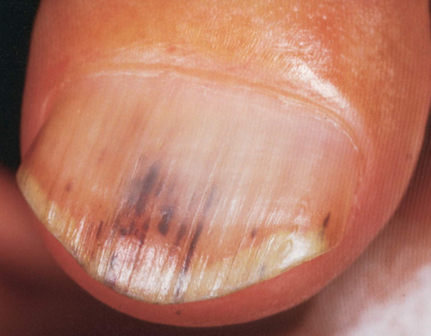 <ul><li><p><span>most commonly trauma related</span></p></li><li><p><span>can be a peripheral sign of <strong>infective endocarditis</strong> due to:</span></p><ul><li><p><strong>Microemboli</strong> (tiny clots or infected material from heart valves) traveling through circulation</p><p>or</p></li><li><p><strong>Vasculitis</strong> (immune complex deposition) causing damage to capillaries</p></li></ul></li></ul><p></p>