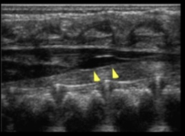 <p>What is demonstrated on the spine image?</p>